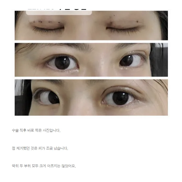 Non-incisional double eyelid surgery — Afternoon Plastic Surgery 2