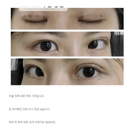 Non-incisional double eyelid surgery 2