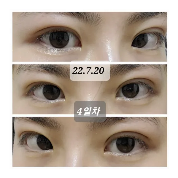Non-incisional double eyelid surgery — Afternoon Plastic Surgery 3