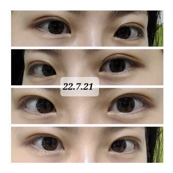 Non-incisional double eyelid surgery — Afternoon Plastic Surgery 4