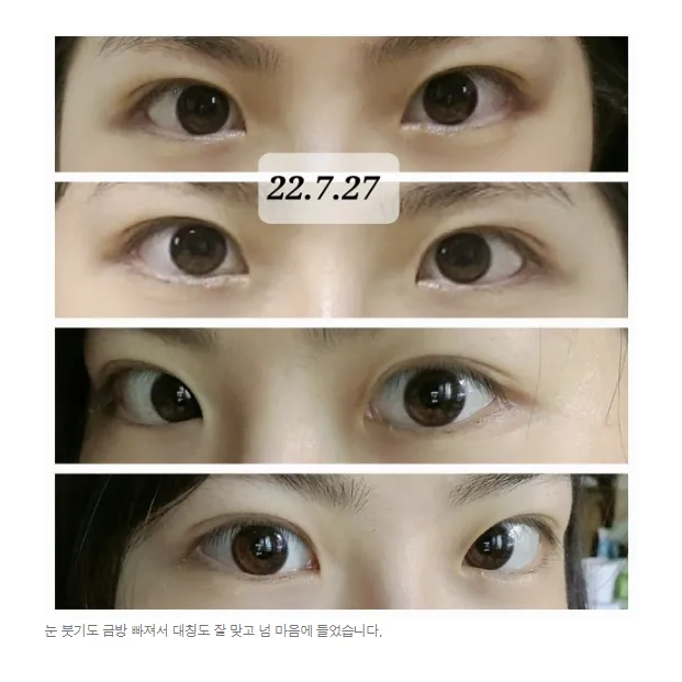 Non-incisional double eyelid surgery — Afternoon Plastic Surgery 5