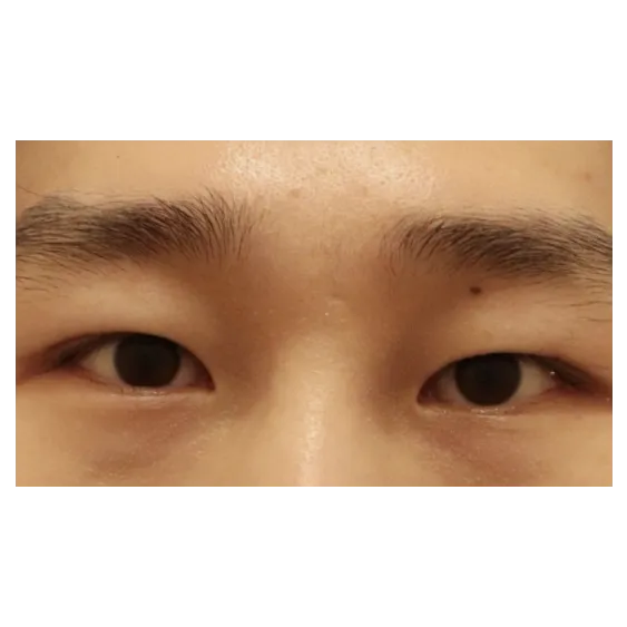 Incisional Double Eyelid Surgery — Afternoon Plastic Surgery 2
