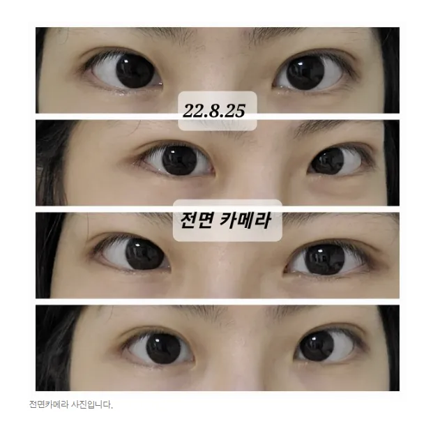 Non-incisional double eyelid surgery — Afternoon Plastic Surgery 6
