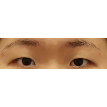 Incisional Double Eyelid Surgery, Ptosis Correction 1
