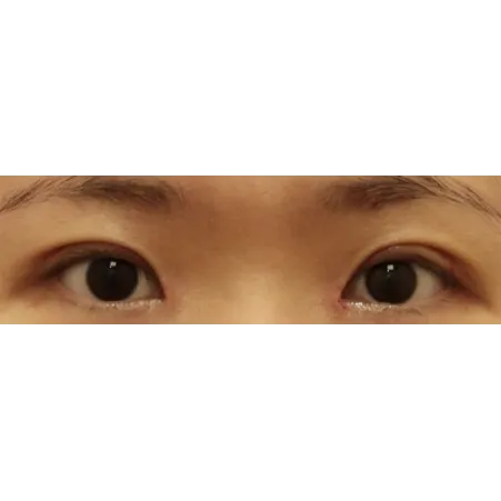 Incisional Double Eyelid Surgery, Ptosis Correction 2