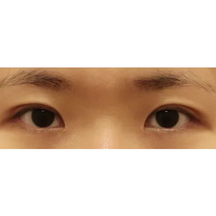 Incisional Double Eyelid Surgery, Ptosis Correction — Afternoon Plastic Surgery 3
