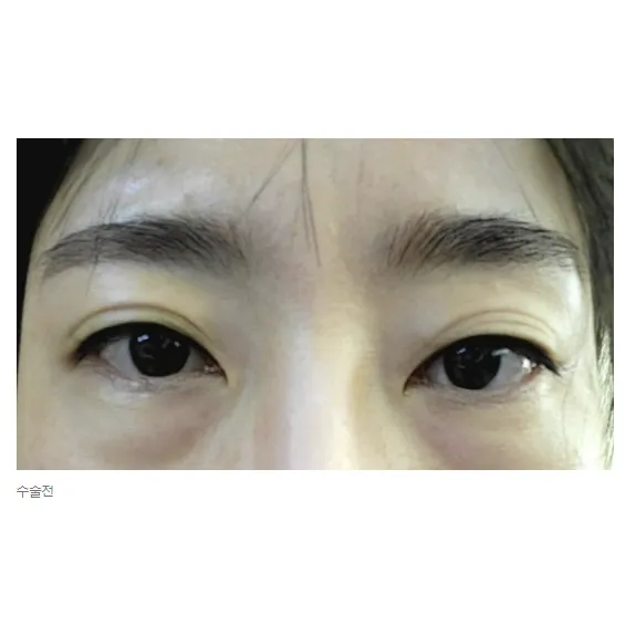 Revision ptosis correction, Incisional Double Eyelid Surgery 1