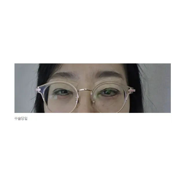 Revision ptosis correction, Incisional Double Eyelid Surgery — Afternoon Plastic Surgery 2