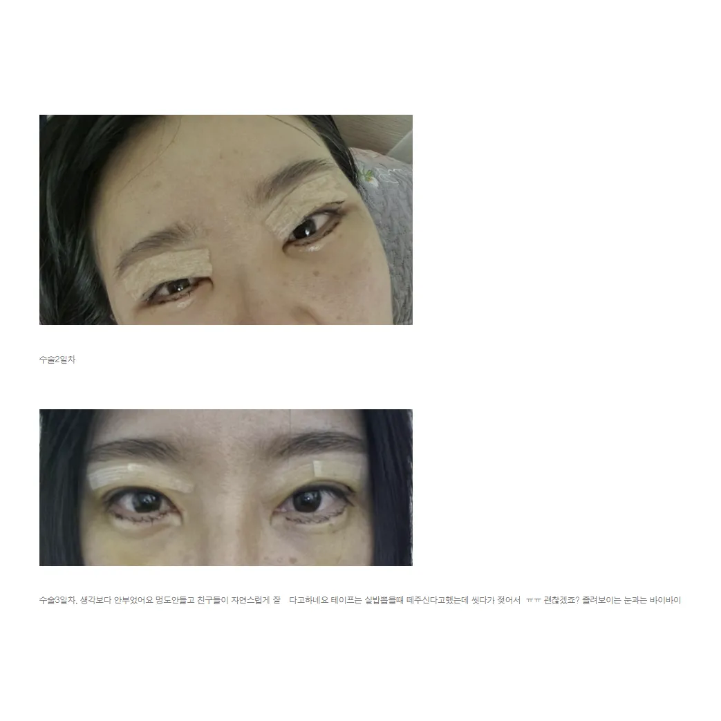 Revision ptosis correction, Incisional Double Eyelid Surgery — Afternoon Plastic Surgery 3