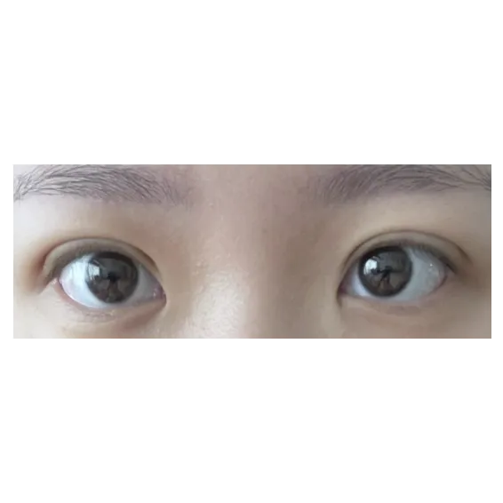 Ptosis Correction, Non-incisional double eyelid surgery — Afternoon Plastic Surgery 2