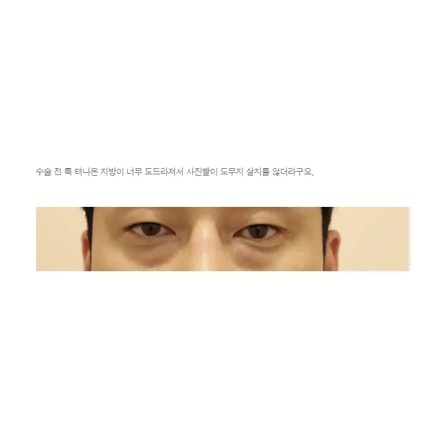 Lower Eyelid Fat Repositioning 1