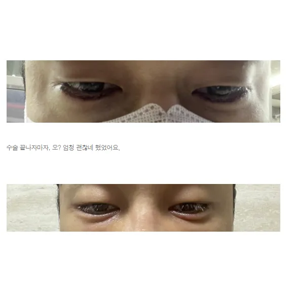 Lower Eyelid Fat Repositioning 2