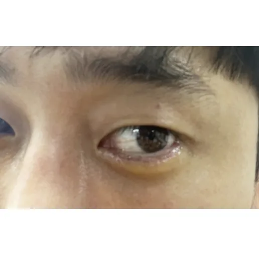 Lower Eyelid Fat Repositioning — Afternoon Plastic Surgery 3