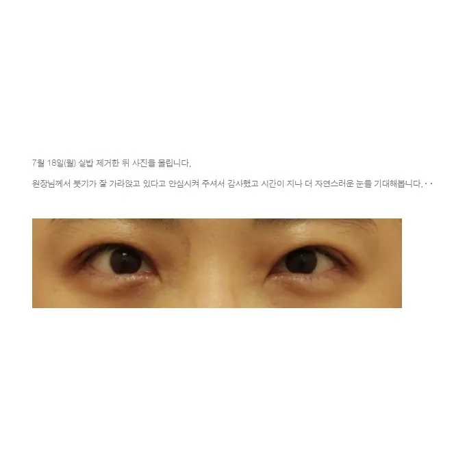 Incisional Double Eyelid Surgery, Ptosis Correction — Afternoon Plastic Surgery 2