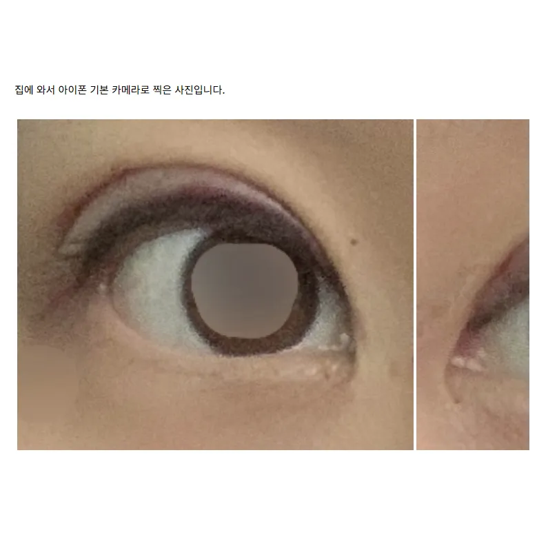 Revision ptosis correction 1