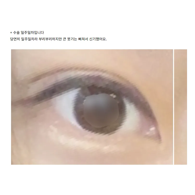 Revision ptosis correction 2