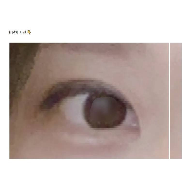 Revision ptosis correction — Afternoon Plastic Surgery 3