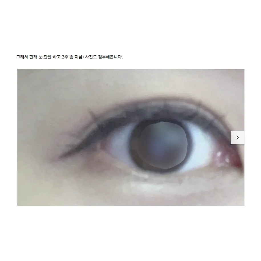 Revision ptosis correction — Afternoon Plastic Surgery 4