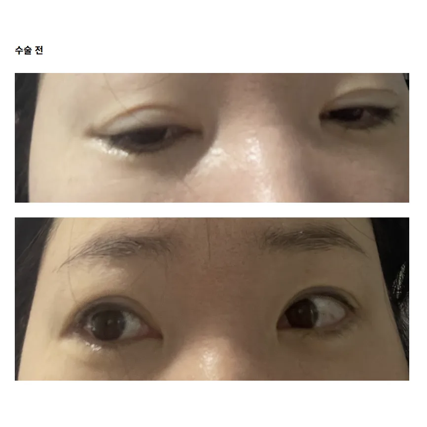 Revision ptosis correction 1