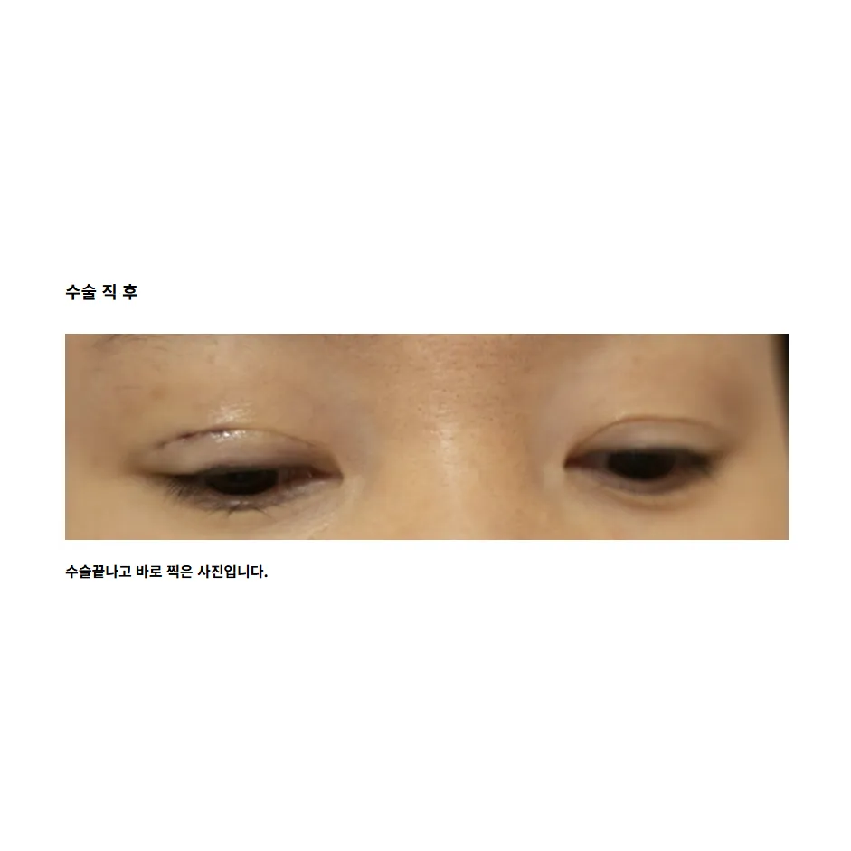 Revision ptosis correction 2