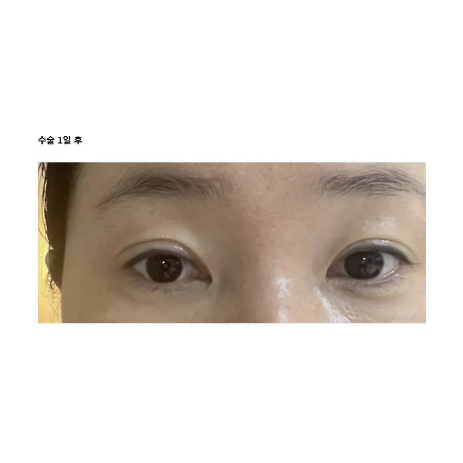 Revision ptosis correction — Afternoon Plastic Surgery 3