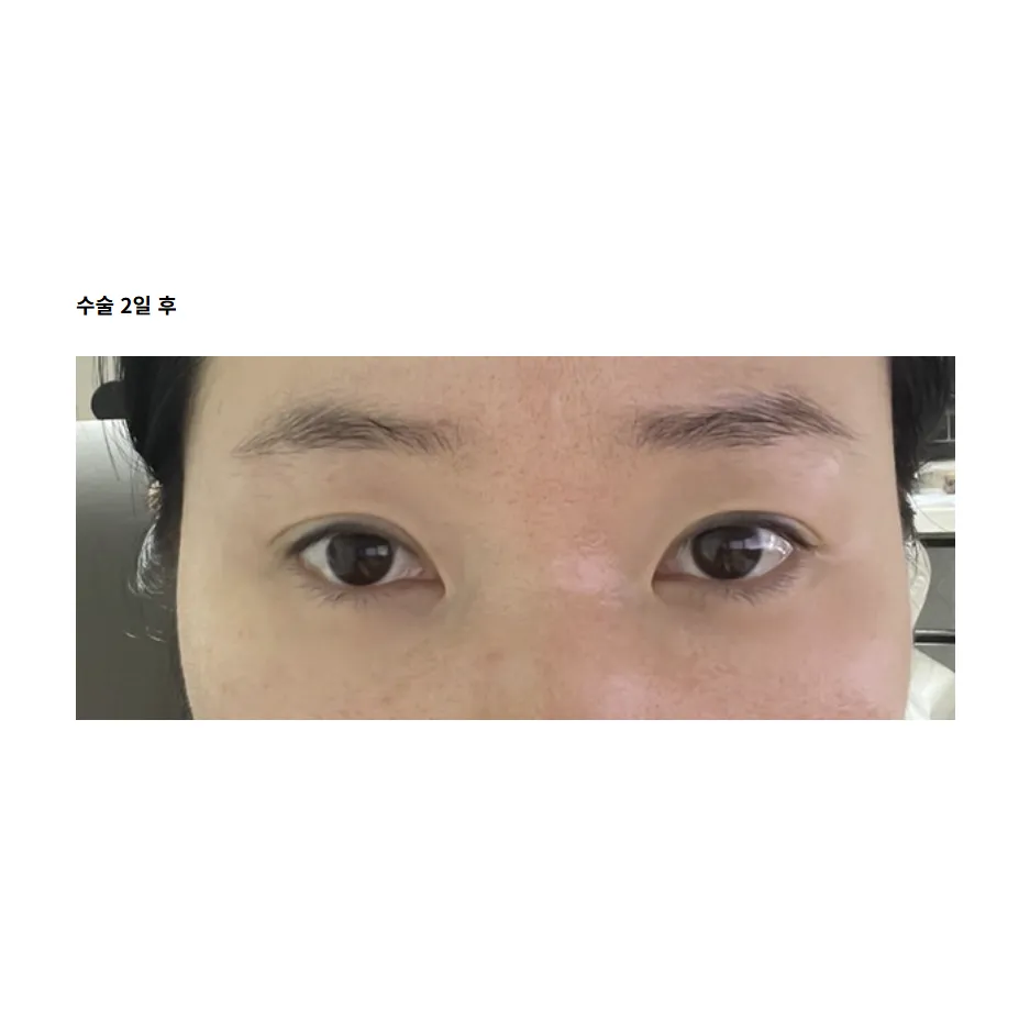 Revision ptosis correction — Afternoon Plastic Surgery 4