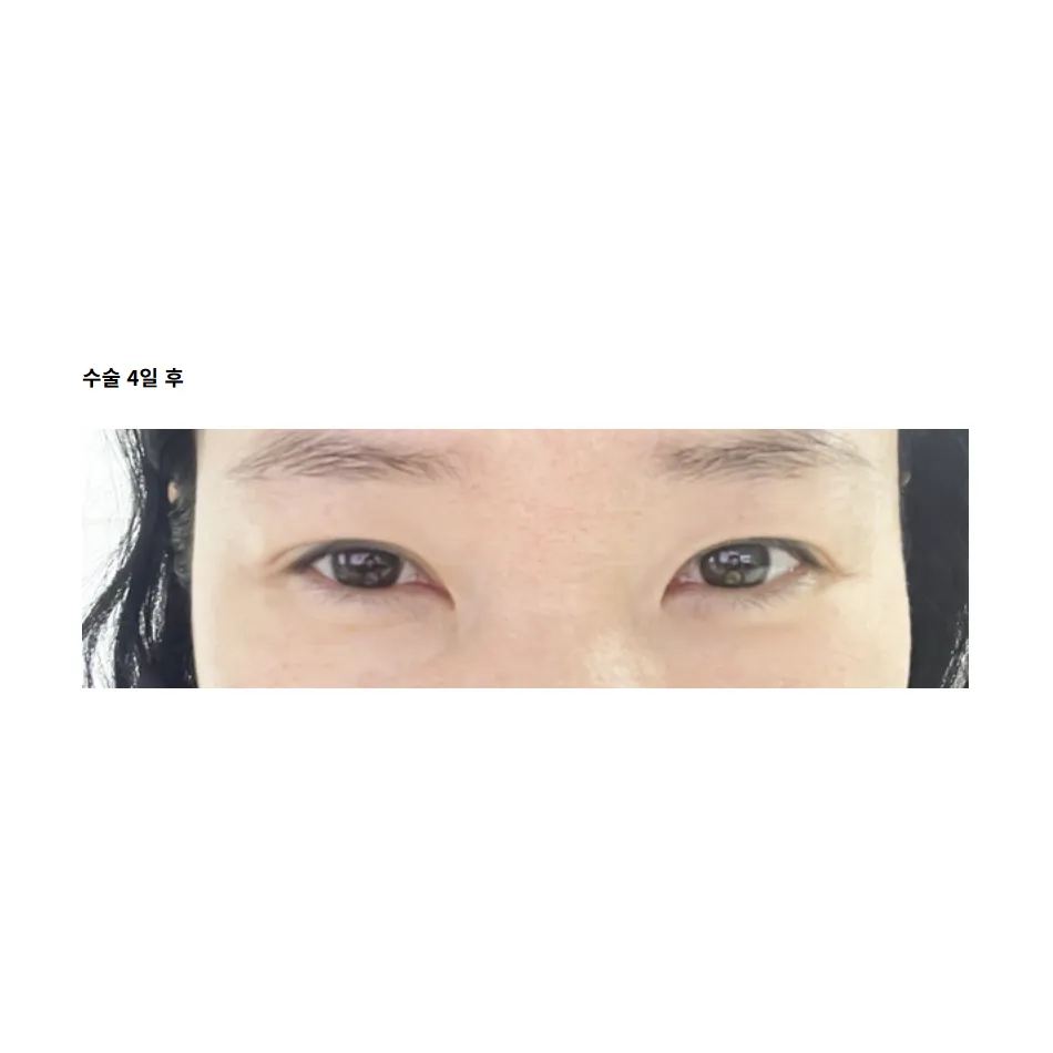Revision ptosis correction — Afternoon Plastic Surgery 5