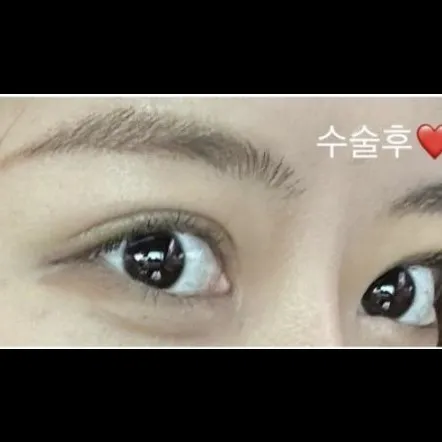 Revision ptosis correction 2