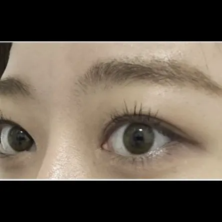 Revision ptosis correction — Afternoon Plastic Surgery 3