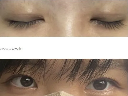 Puffy Eyelid Correction — Afternoon Plastic Surgery 2