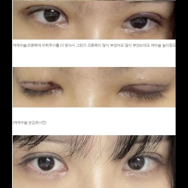Puffy Eyelid Correction 1