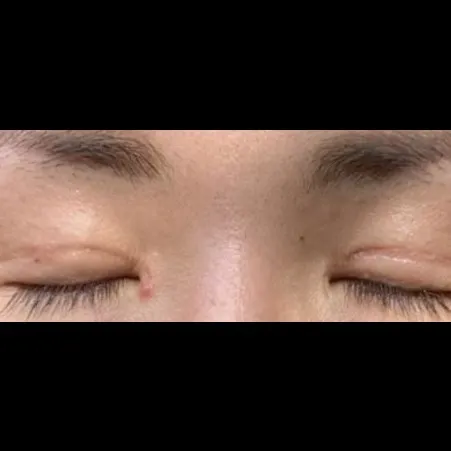 不自然な二重ライン修正 — Afternoon Plastic Surgery 1