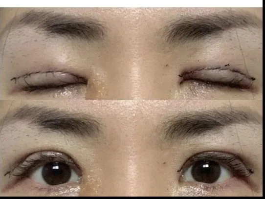Puffy Eyelid Correction 2
