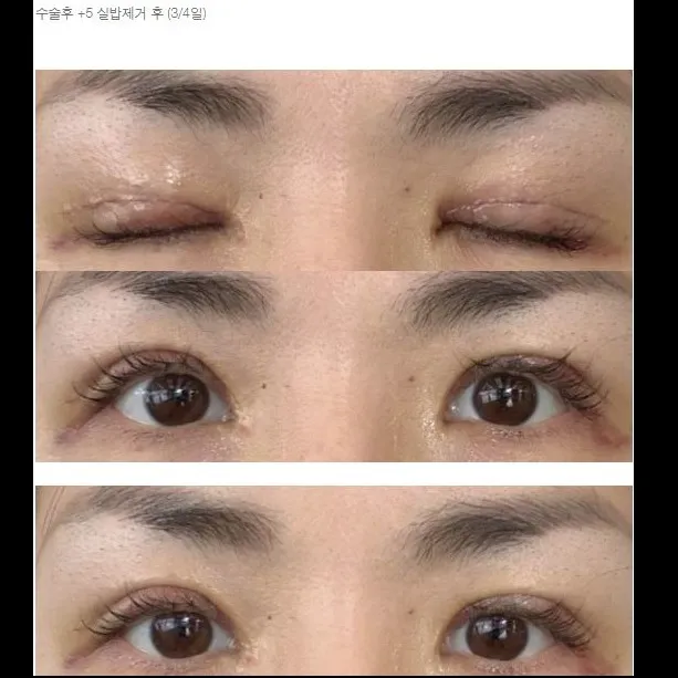 不自然な二重ライン修正 — Afternoon Plastic Surgery 3