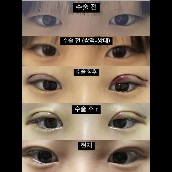 Incisional Double Eyelid Surgery — Afternoon Plastic Surgery 1