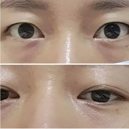 Non-incisional double eyelid surgery, Lower Eyelid Fat Repositioning 1