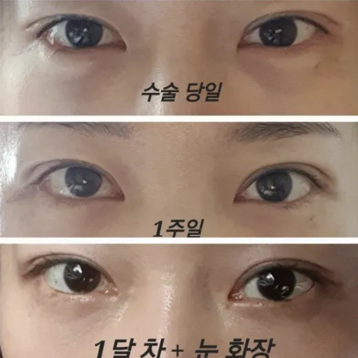 Non-incisional double eyelid surgery, Lower Eyelid Fat Repositioning 2