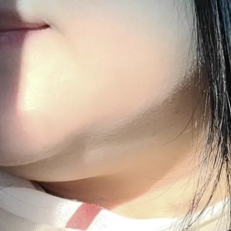 Mini Facelift — Afternoon Plastic Surgery 1