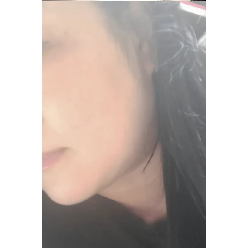 Mini Facelift — Afternoon Plastic Surgery 2
