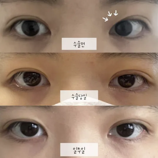 Non-incisional double eyelid surgery — Afternoon Plastic Surgery 1