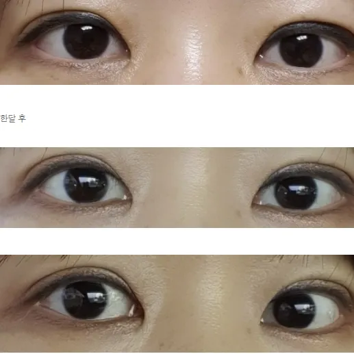 Revision ptosis correction — Afternoon Plastic Surgery 2