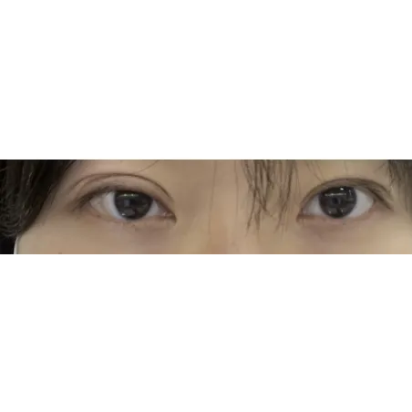 Revision ptosis correction, Puffy Eyelid Correction — Afternoon Plastic Surgery 1