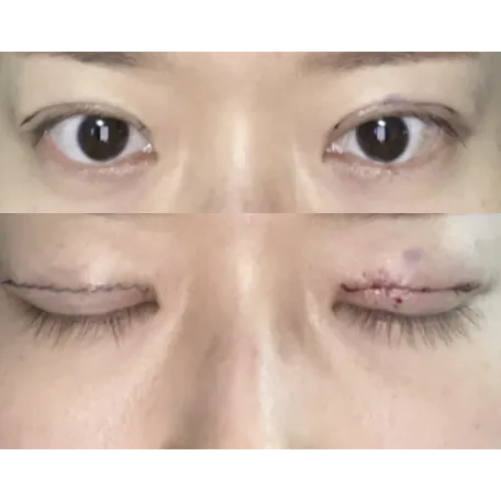 Revision ptosis correction, Puffy Eyelid Correction 2