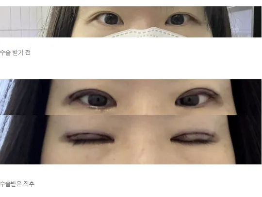 Revision ptosis correction, Epicanthoplasty 1