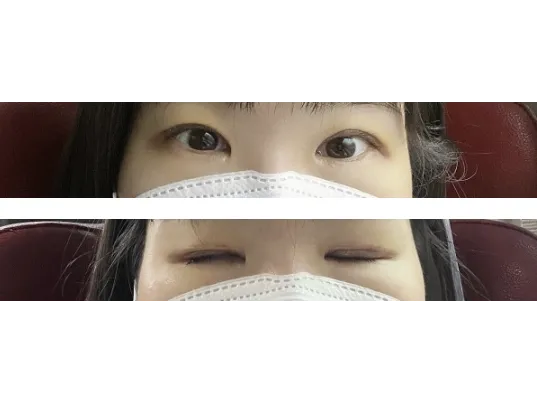 Revision ptosis correction, Epicanthoplasty — Afternoon Plastic Surgery 2