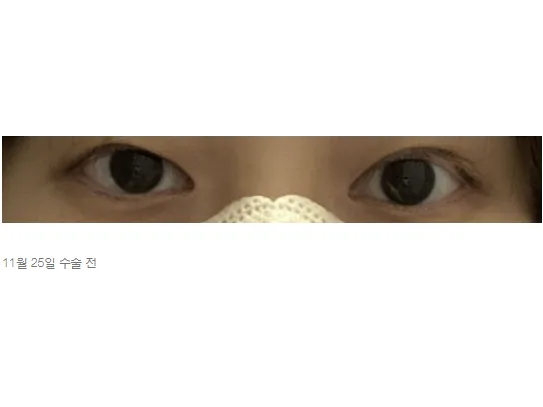 Non-incisional double eyelid surgery 1