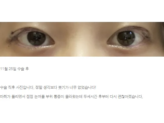 Non-incisional double eyelid surgery 2