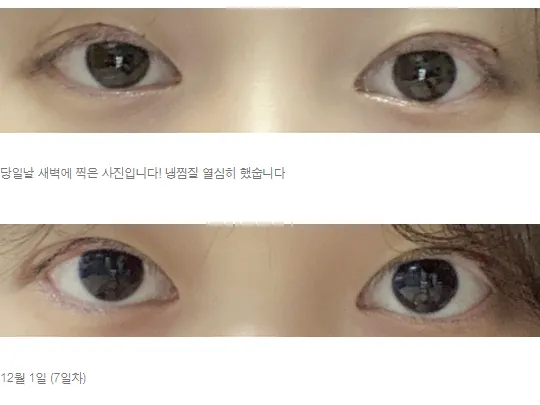 Non-incisional double eyelid surgery — Afternoon Plastic Surgery 3