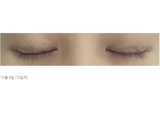 Non-incisional double eyelid surgery — Afternoon Plastic Surgery 4