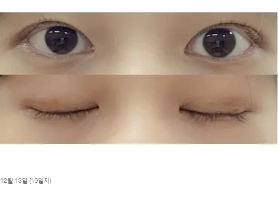 Non-incisional double eyelid surgery — Afternoon Plastic Surgery 5